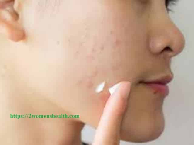 Best Acne Scar Treatment – Comestic
